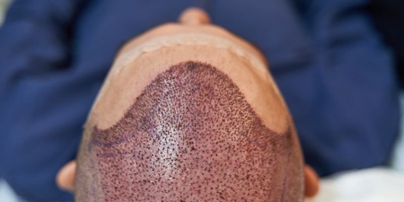 How Mesotherapy Can Help with Hair Loss and Regrowth