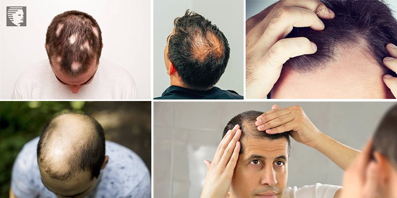What Causes Male Pattern Baldness