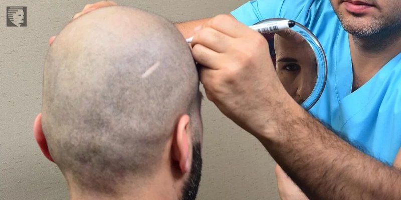 What are the Types Of Treatment Available For Hair Loss