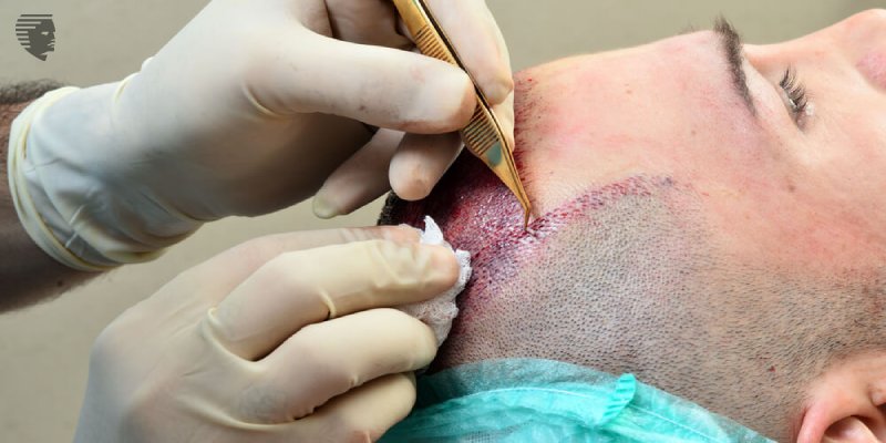 What Is the Price of the Hair Hair Transplant in Gurgaon?