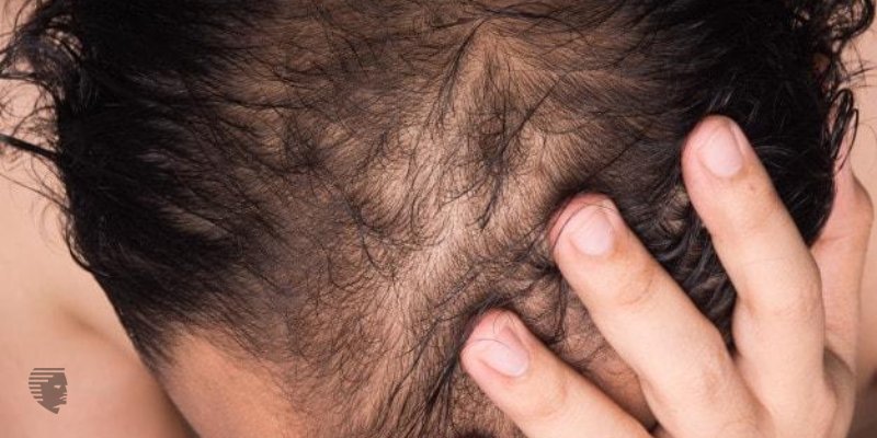How Much Does Laser Hair Treatment Cost in India?