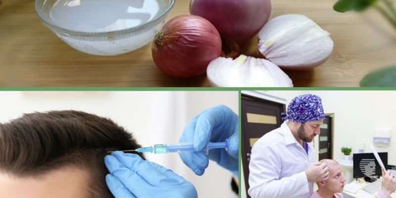 بهترین درمان برای ریزش موی جلوی سر چیست؟