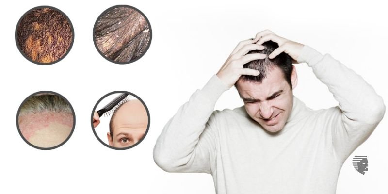 What Is an Itchy Scalp a Symptom Of?
