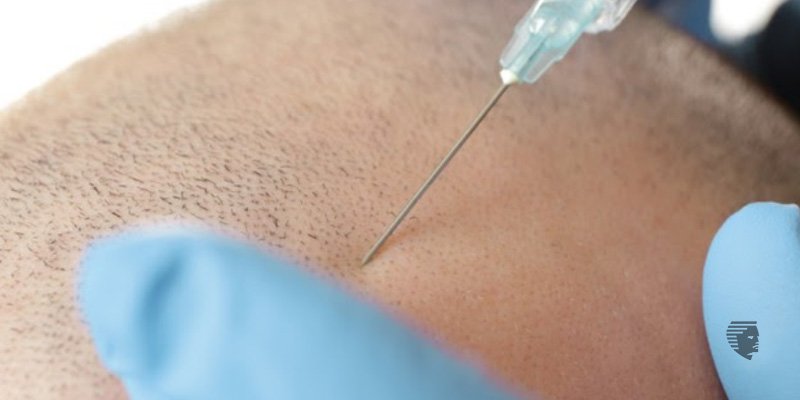 Hair transplant