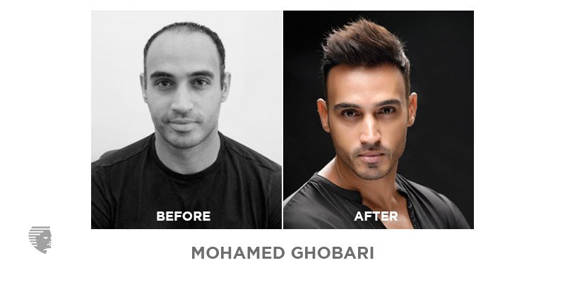 چگونه طاسی را متوقف کنیم