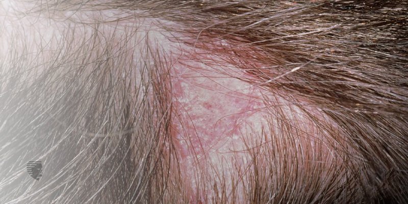 Scalp Ringworm