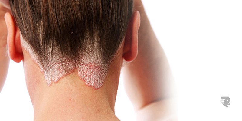 Psoriasis