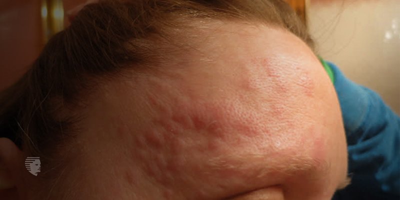 Hives