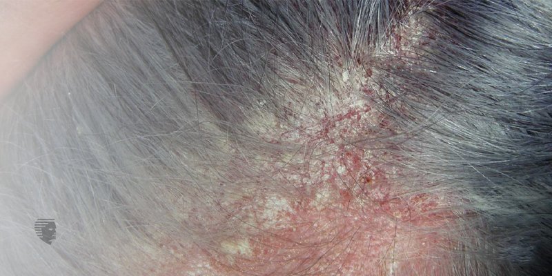 Seborrheic Dermatitis