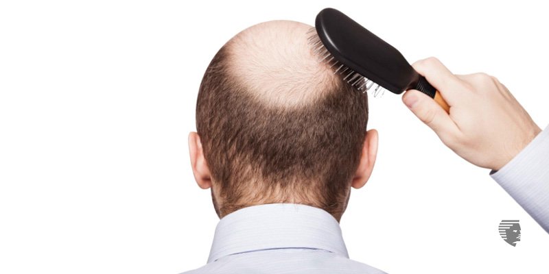 علائم آلوپسی آره آتا چیست؟