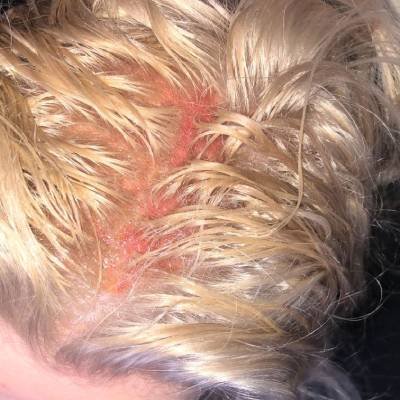 Bleaching Hurts the Scalp