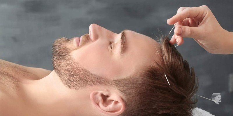 How can Acupuncture help with hair loss