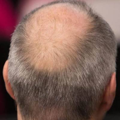 ماسک موی کفیر برای جلوگیری از طاسی