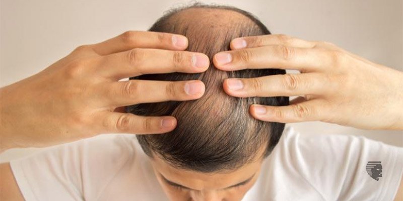 How do I deal with Hair Loss after Chemo?