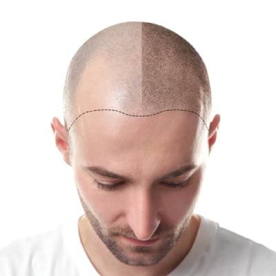 کاشت مو نه برای افراد جوان و نه برای افراد مسن است