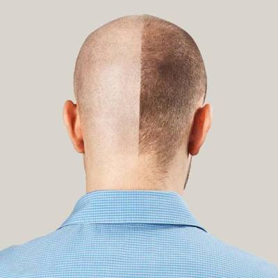 موهای شخص دیگری در طول کاشت استفاده میشود